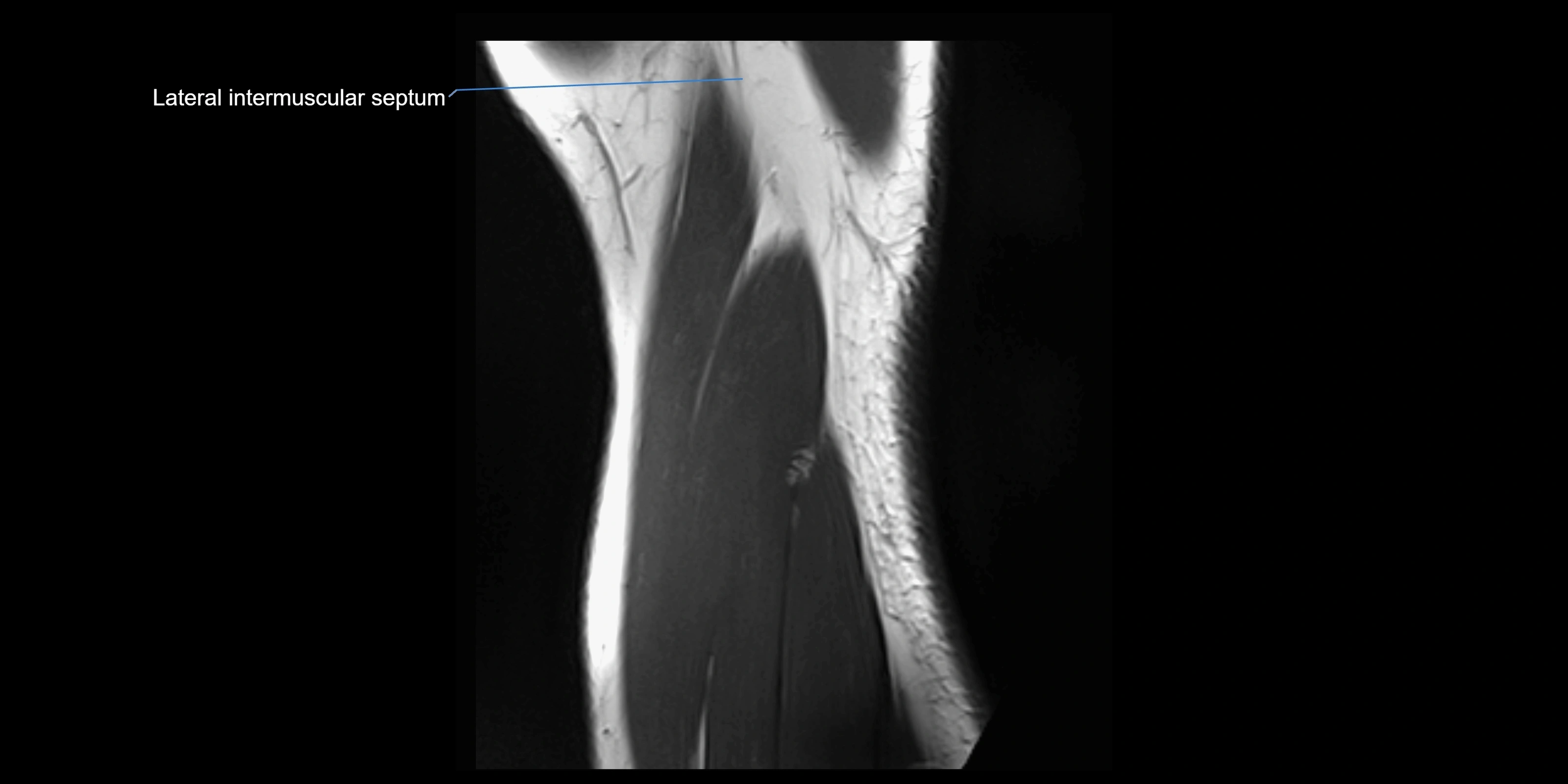 MRI elbow sagittal cross sectional anatomy 3T radiology  image-img-00001-00023.webp